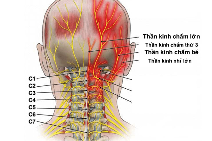 Dây thần kinh chẩm tổn thương sẽ gây ra đau đầu kèm nhiều triệu chứng khác