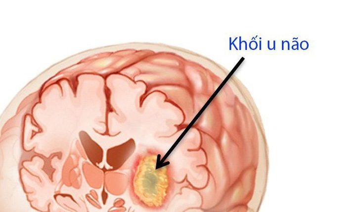 Não có khối u sẽ gây ra đau đầu dữ dội
